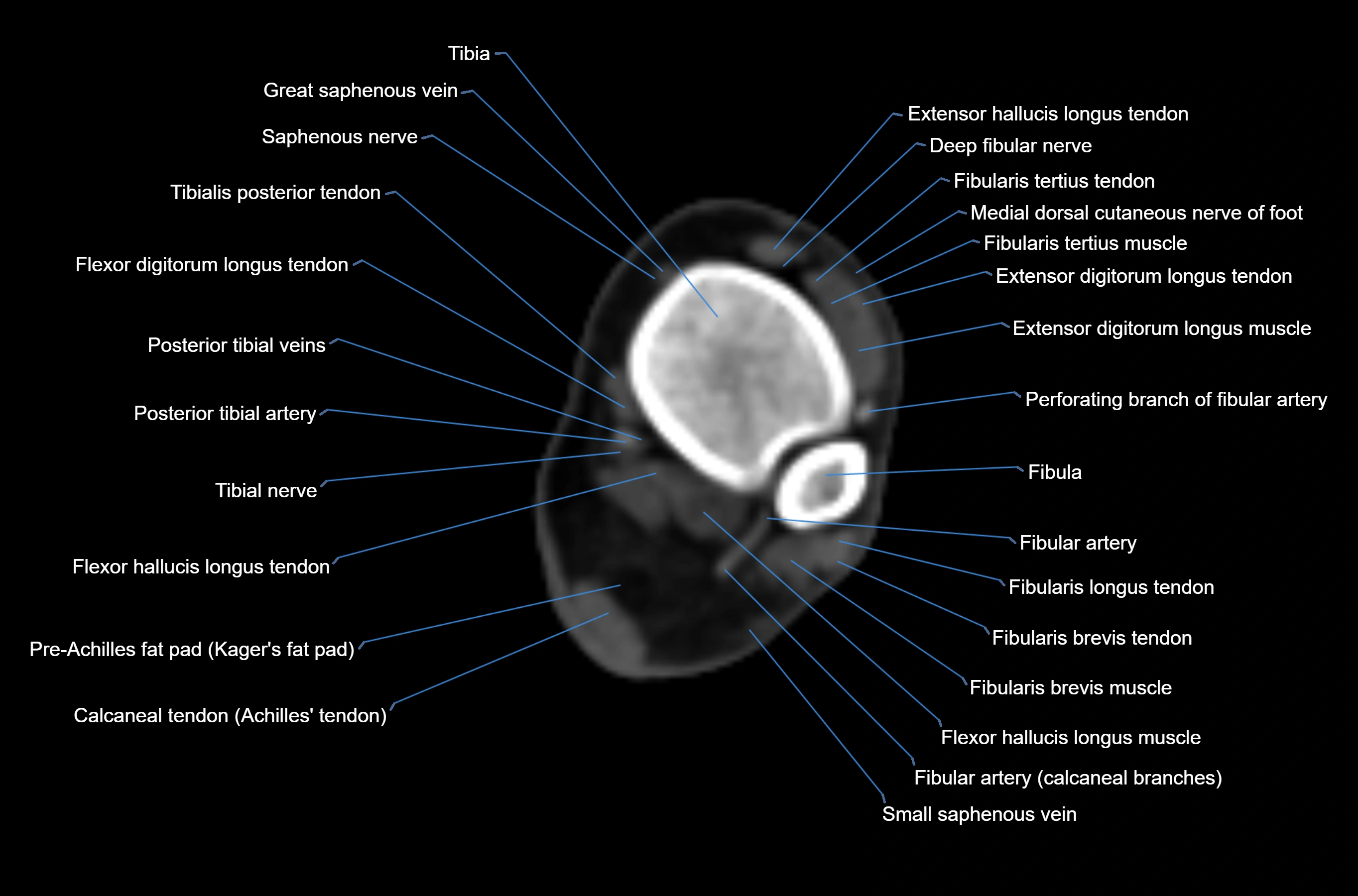 CT Ankle axial cross sectional anatomy labelled image -00023.webp